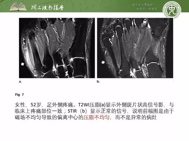 【PPT】骨骼肌肉系统肿块影像学成像基本概念