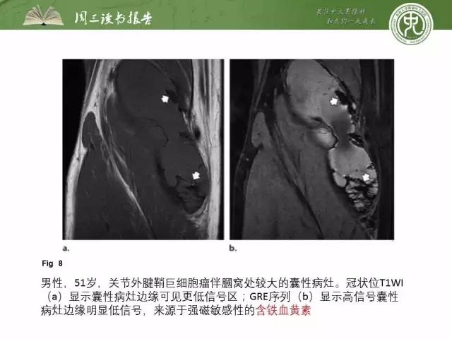 【PPT】骨骼肌肉系统肿块影像学成像基本概念