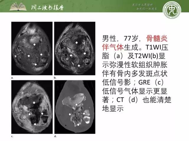 【PPT】骨骼肌肉系统肿块影像学成像基本概念