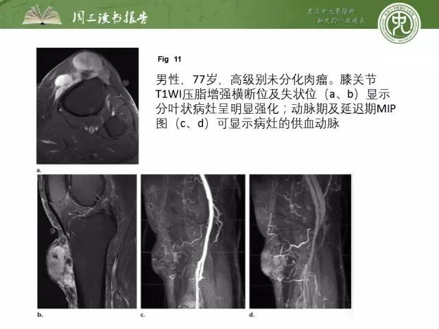 【PPT】骨骼肌肉系统肿块影像学成像基本概念