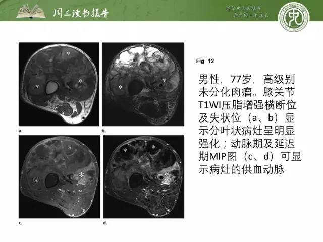 【PPT】骨骼肌肉系统肿块影像学成像基本概念