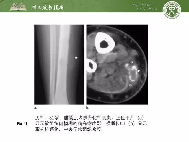 【PPT】骨骼肌肉系统肿块影像学成像基本概念