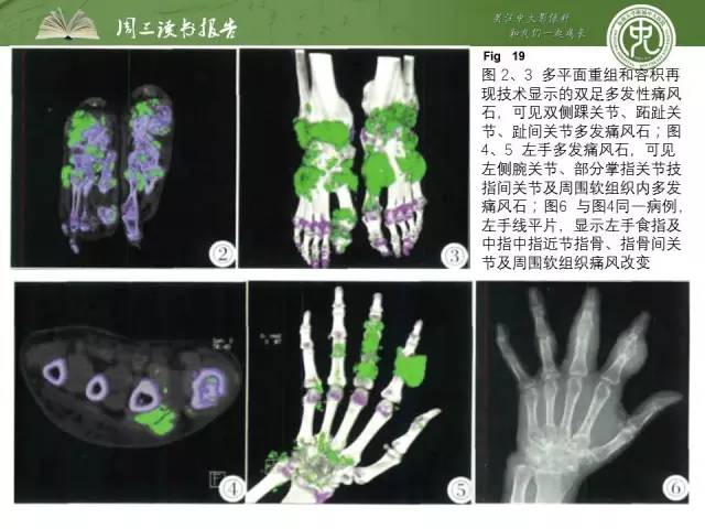 【PPT】骨骼肌肉系统肿块影像学成像基本概念
