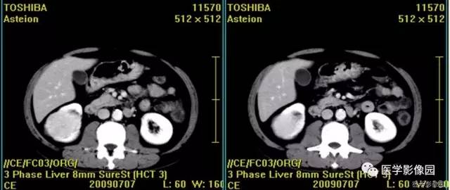 【病例】乏脂肪肾血管平滑肌脂肪瘤1例CT影像表现 【病例】乏脂肪肾血管平滑肌脂肪瘤1例CT影像表现