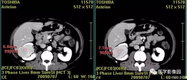 【病例】乏脂肪肾血管平滑肌脂肪瘤1例CT影像表现 【病例】乏脂肪肾血管平滑肌脂肪瘤1例CT影像表现