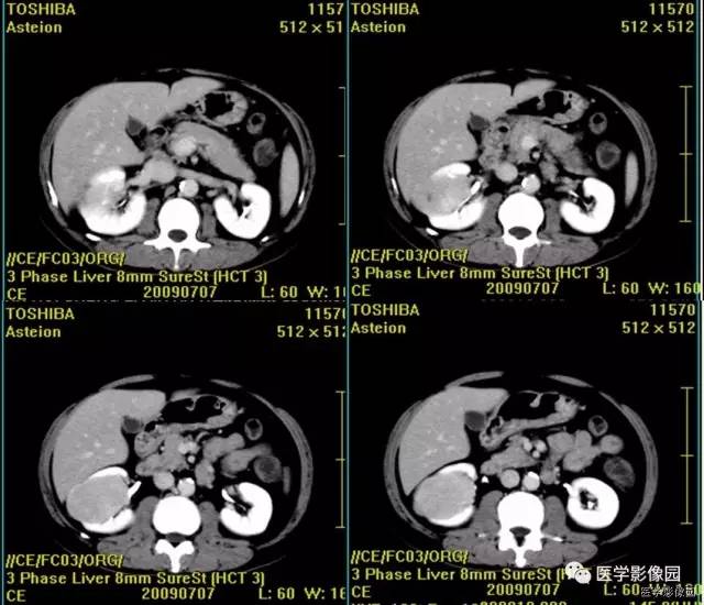 【病例】乏脂肪肾血管平滑肌脂肪瘤1例CT影像表现 【病例】乏脂肪肾血管平滑肌脂肪瘤1例CT影像表现