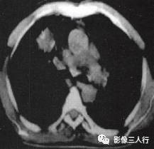 “锯齿征” 的影像表现与临床意义 “锯齿征” 的影像表现与临床意义