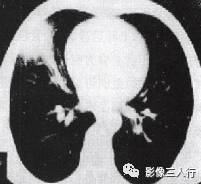 “锯齿征” 的影像表现与临床意义 “锯齿征” 的影像表现与临床意义