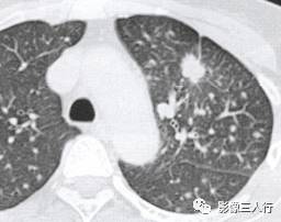 “锯齿征” 的影像表现与临床意义 “锯齿征” 的影像表现与临床意义