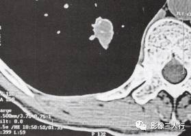 “锯齿征” 的影像表现与临床意义 “锯齿征” 的影像表现与临床意义