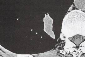 “锯齿征” 的影像表现与临床意义 “锯齿征” 的影像表现与临床意义