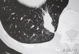 “锯齿征” 的影像表现与临床意义 “锯齿征” 的影像表现与临床意义