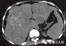 【病例】肝结核瘤1例CT影像分析