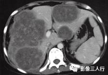 【病例】肝结核瘤1例CT影像分析 【病例】肝结核瘤1例CT影像分析