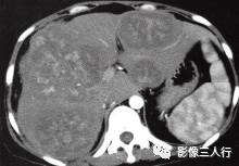 【病例】肝结核瘤1例CT影像分析 【病例】肝结核瘤1例CT影像分析
