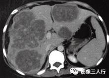 【病例】肝结核瘤1例CT影像分析 【病例】肝结核瘤1例CT影像分析