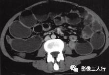 【病例】肝结核瘤1例CT影像分析 【病例】肝结核瘤1例CT影像分析