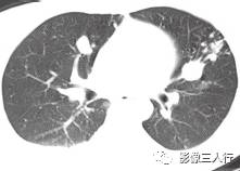 【病例】肝结核瘤1例CT影像分析 【病例】肝结核瘤1例CT影像分析