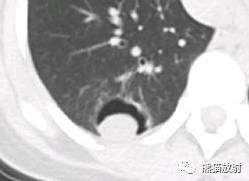 【病例】空洞为主要表现的肺真菌病7例CT影像征象 【病例】空洞为主要表现的肺真菌病7例CT影像征象