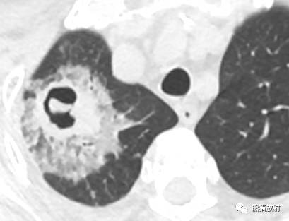 【病例】空洞为主要表现的肺真菌病7例CT影像征象 【病例】空洞为主要表现的肺真菌病7例CT影像征象