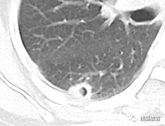【病例】空洞为主要表现的肺真菌病7例CT影像征象 【病例】空洞为主要表现的肺真菌病7例CT影像征象