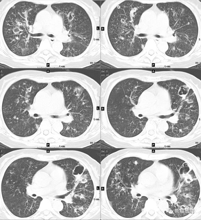 【病例】空洞为主要表现的肺真菌病7例CT影像征象 【病例】空洞为主要表现的肺真菌病7例CT影像征象