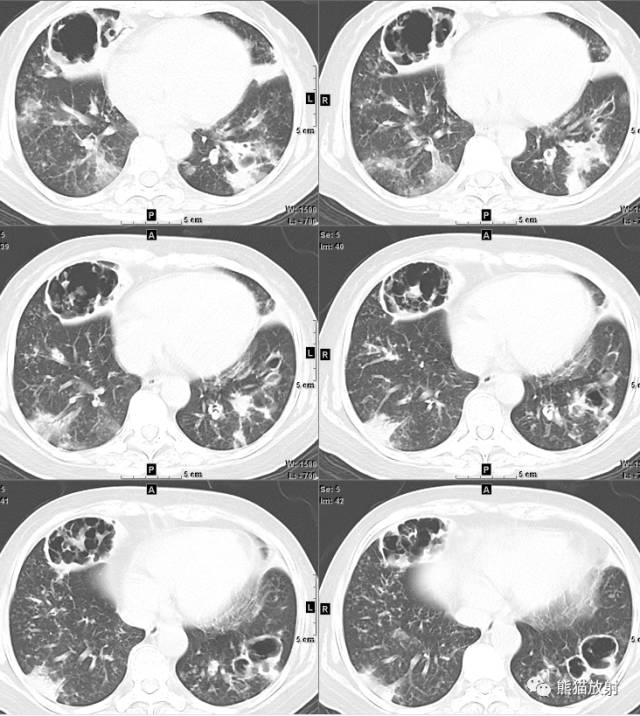 【病例】空洞为主要表现的肺真菌病7例CT影像征象 【病例】空洞为主要表现的肺真菌病7例CT影像征象