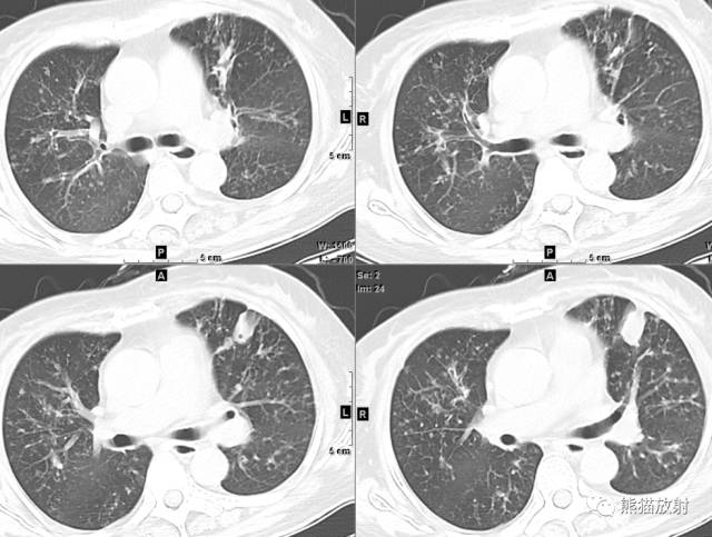 【病例】空洞为主要表现的肺真菌病7例CT影像征象 【病例】空洞为主要表现的肺真菌病7例CT影像征象