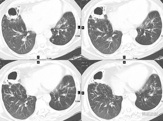 【病例】空洞为主要表现的肺真菌病7例CT影像征象 【病例】空洞为主要表现的肺真菌病7例CT影像征象