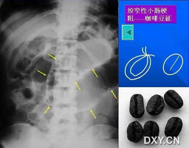 胃肠十大经典影像征象 胃肠十大经典影像征象