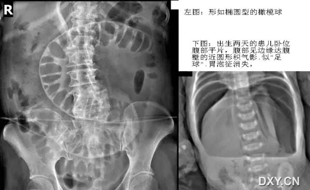 胃肠十大经典影像征象 胃肠十大经典影像征象