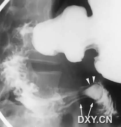 胃肠十大经典影像征象 胃肠十大经典影像征象