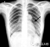 “卵壳状钙化征” 的影像表现与临床意义 “卵壳状钙化征” 的影像表现与临床意义