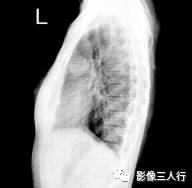 “卵壳状钙化征” 的影像表现与临床意义 “卵壳状钙化征” 的影像表现与临床意义