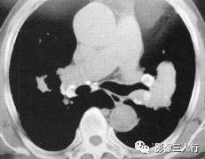 “卵壳状钙化征” 的影像表现与临床意义 “卵壳状钙化征” 的影像表现与临床意义