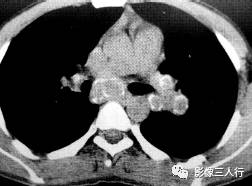 “卵壳状钙化征” 的影像表现与临床意义 “卵壳状钙化征” 的影像表现与临床意义