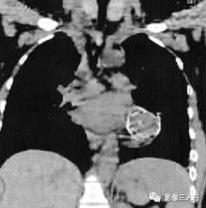 “卵壳状钙化征” 的影像表现与临床意义 “卵壳状钙化征” 的影像表现与临床意义