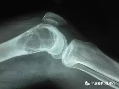 骨巨细胞瘤的分级分期及影像表现