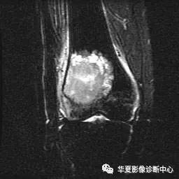 骨巨细胞瘤的分级分期及影像表现