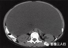【病例】卵巢桨液性囊腺瘤1例CT影像分析