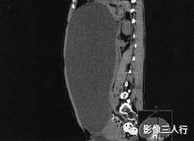 【病例】卵巢桨液性囊腺瘤1例CT影像分析