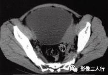 【病例】卵巢桨液性囊腺瘤1例CT影像分析