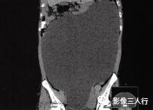 【病例】卵巢桨液性囊腺瘤1例CT影像分析