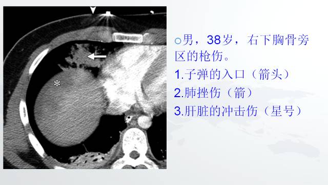 【PPT】穿透性经纵隔损伤的影像学评估