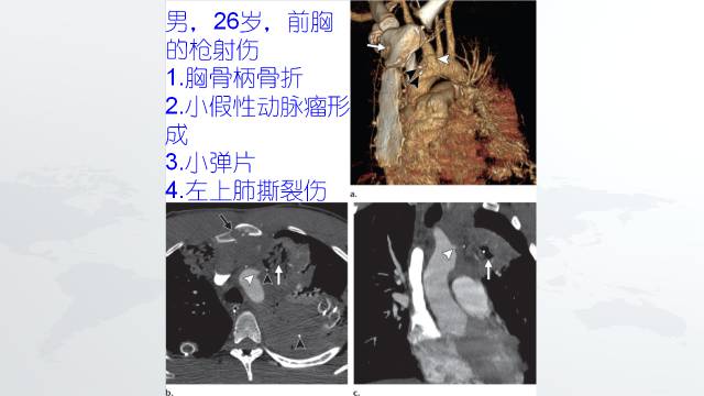 【PPT】穿透性经纵隔损伤的影像学评估