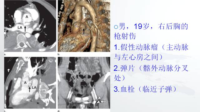 【PPT】穿透性经纵隔损伤的影像学评估