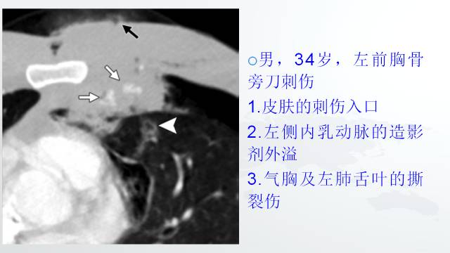 【PPT】穿透性经纵隔损伤的影像学评估