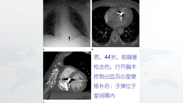 【PPT】穿透性经纵隔损伤的影像学评估