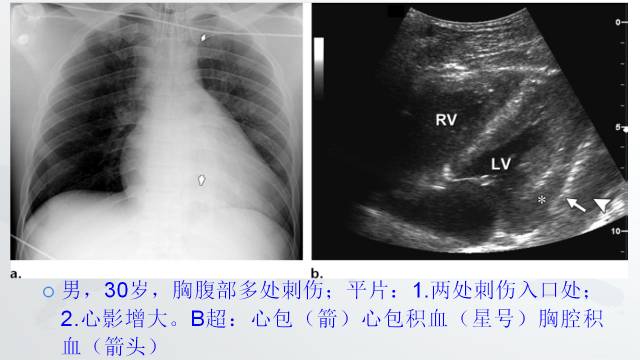 【PPT】穿透性经纵隔损伤的影像学评估