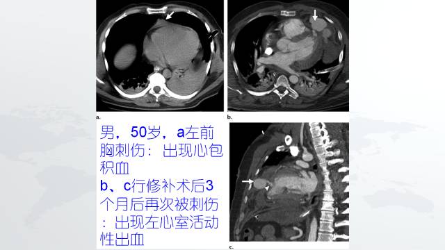 【PPT】穿透性经纵隔损伤的影像学评估